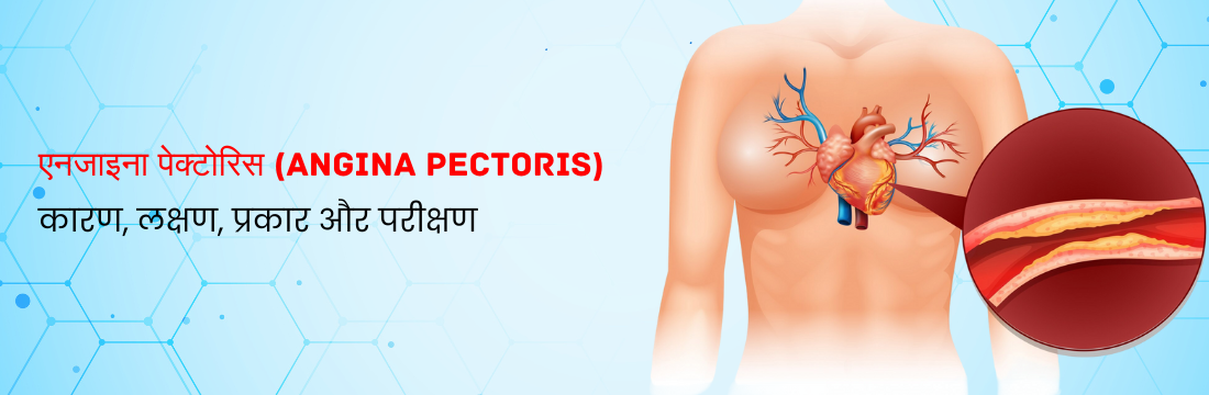 एनजाइना पेक्टोरिस: कारण, लक्षण, प्रकार और परीक्षण